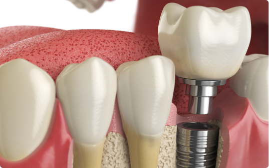 All About Dental Implants Image