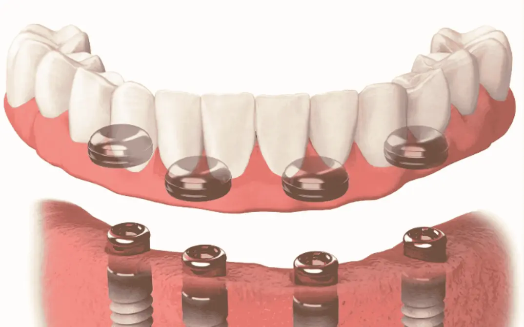 Implant-Retained Overdentures