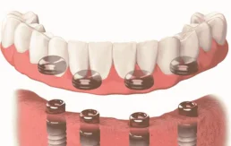 Dental implants