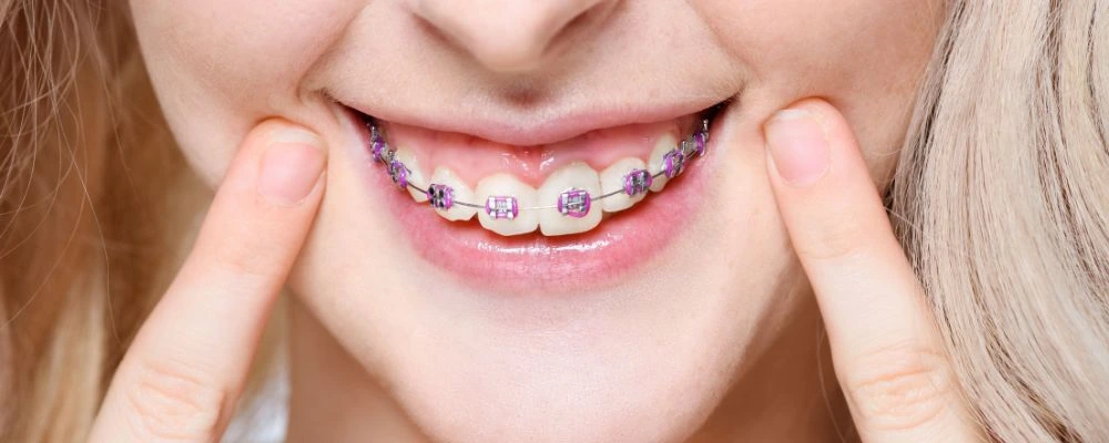 Clear braces treatment at Access Dental Center