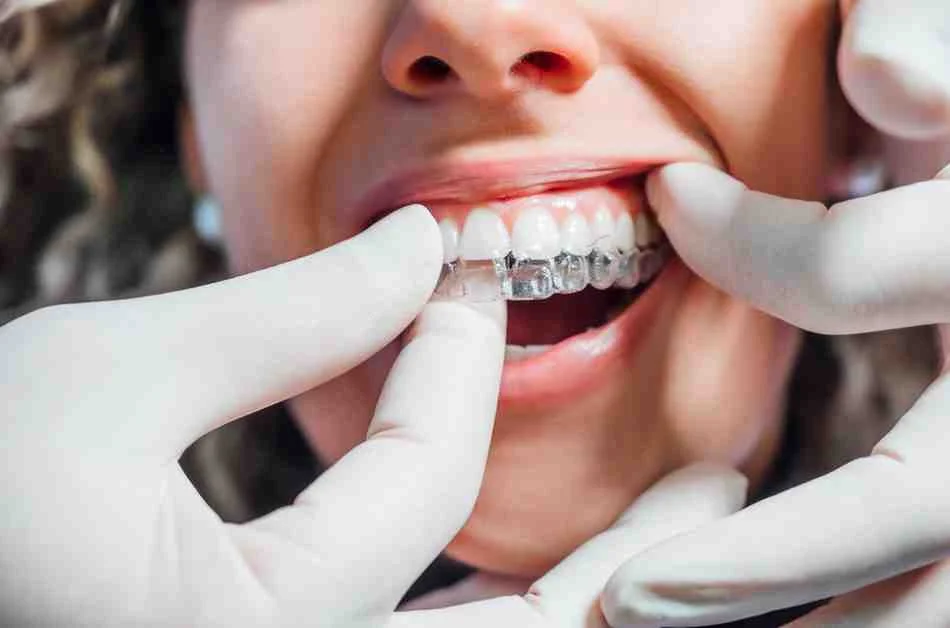 Clean and clear braces for dental patients