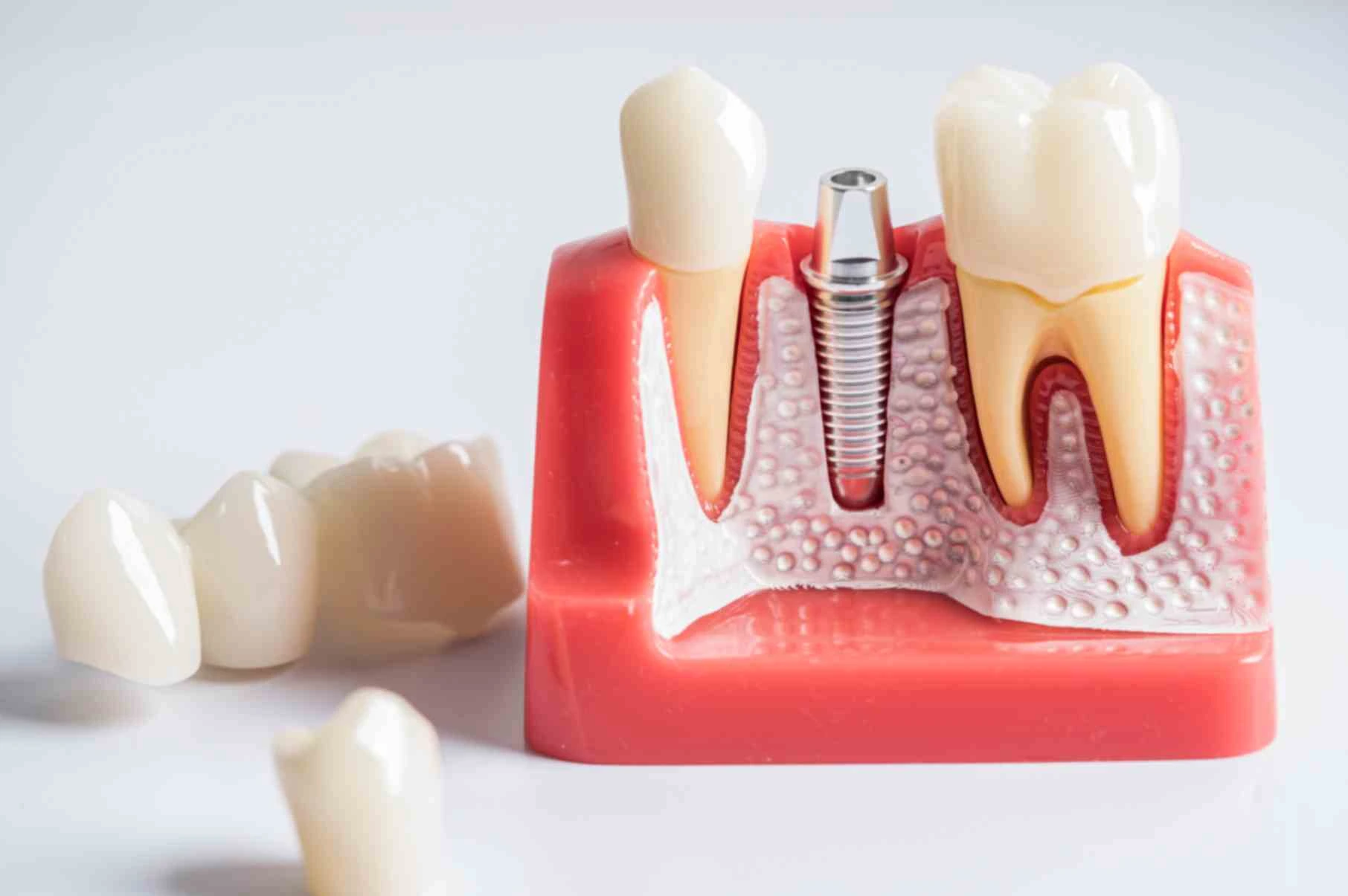 Dental implants and dentures