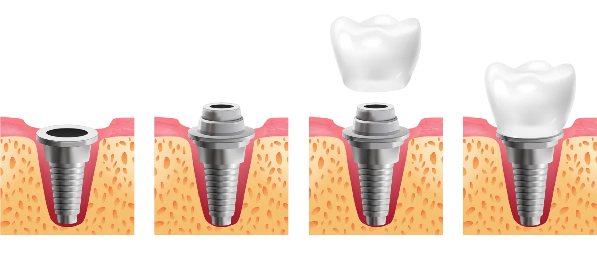 Dental Implant Installation Procedure Image